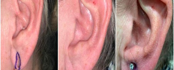 What Causes Split Earlobes And How Do You Fix Them?