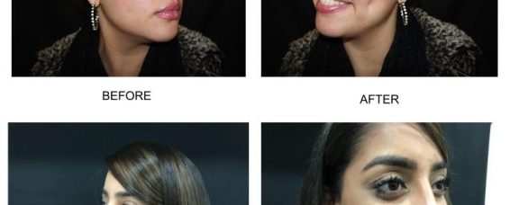 The Fact, Fiction & Fashion Of Facial Dimple Creation