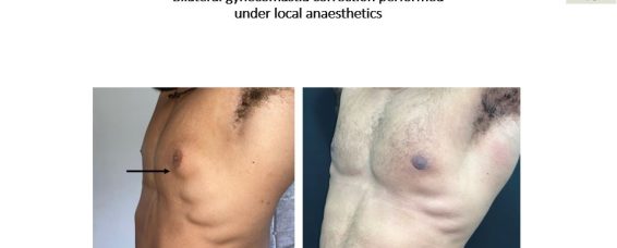 What Causes Gynaecomastia & What Can You Do About It?