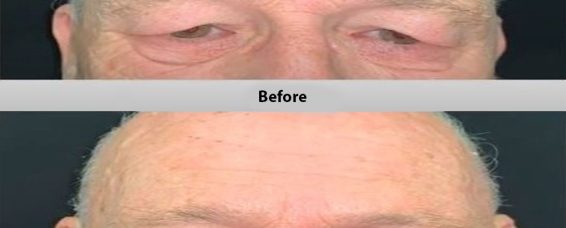 5 FAQs About Eyelid Surgery