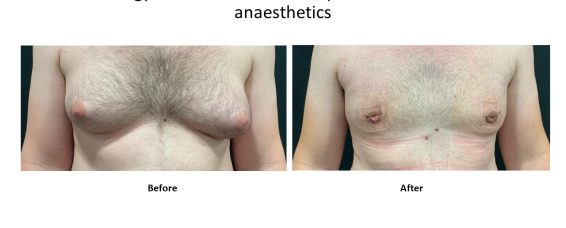 Our observations of ‘Why men are (increasingly) seeking surgical correction of gynaecomastia ( male breast , moobs)