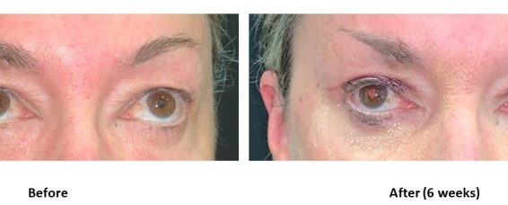 Cosmestic Surgery – Upper Blepharoplasty (Hooded Upper Eyelid)