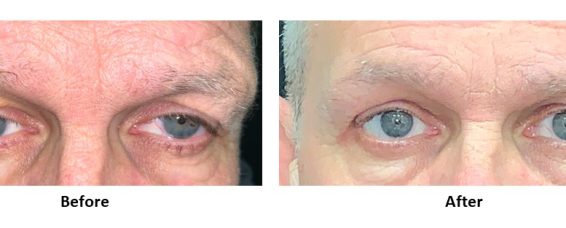 Correction of Upper/Lower Eyelids (Blepharoplasty Procedure) at MACS Clinic