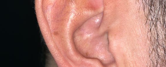 Ear Lobe (lobule) reduction under local anaesthetics at MACS Clinic