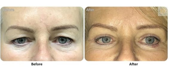 Lower Blepharoplasty Procedure At MACS Clinic