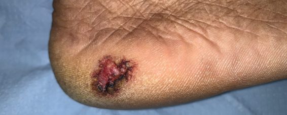 Long-Standing Non-Healing Ulcers on the Sole of the Foot: The Importance of Biopsy to Rule Out Marjolin’s Ulcer / Invasive skin cancer at MACS Clinic