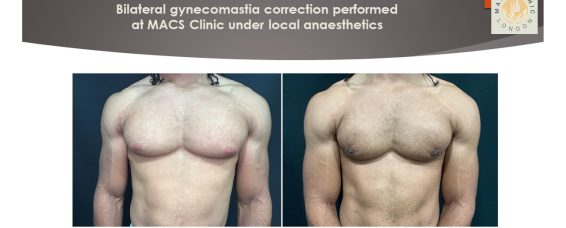 Male Breast Reduction (Correction of Gynecomastia) at MACS Clinic