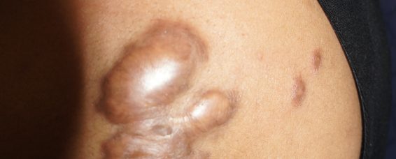 The Role of Local Steroid Injections in Keloid Treatment at MACS Clinic