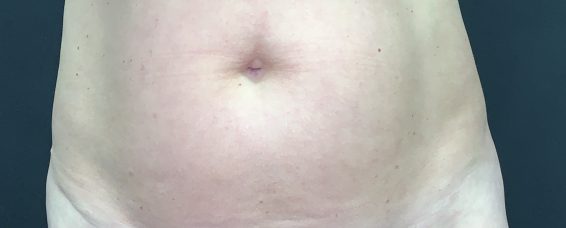 Umbilicoplasty- Reshaping the tummy button at MACS Clinic