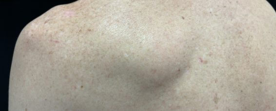 Treatment for Lipomas and Dercum’s Disease at MACS Clinic