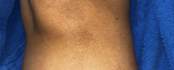 Understanding Dermatofibroma and Its Management at MACS Clinic