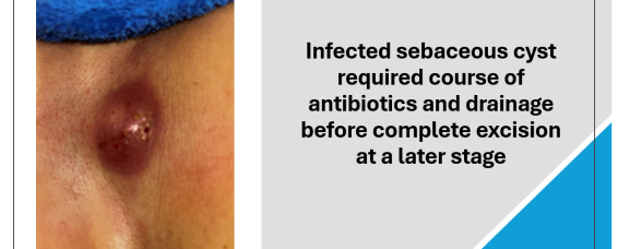 Management of an  Infected Sebaceous Cysts at MACS Clinic