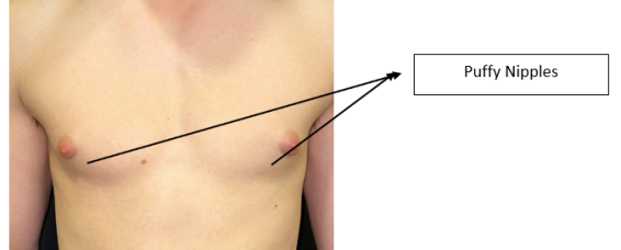 Puffy Nipples (Gynecomastia) Man’s Nightmare ! – Causes, Concerns & Correction at MACS Clinic