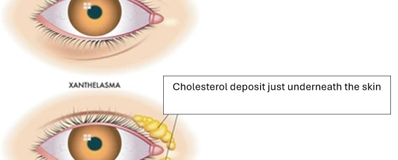 Xanthelasma: Causes, Symptoms, and Treatment at MACS Clinic