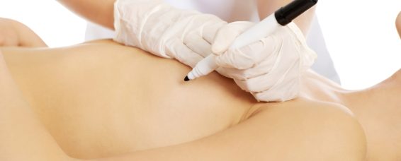 Breast Augmentation at MACS Clinic